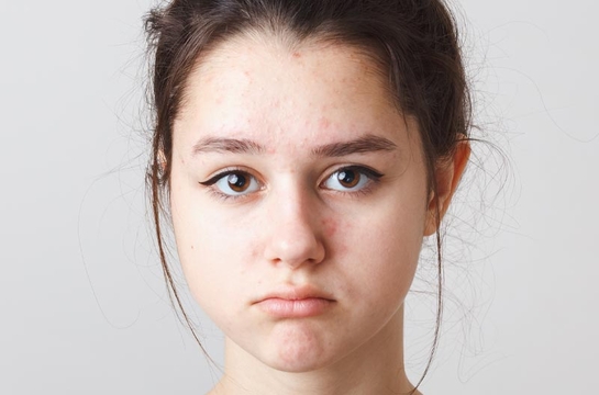 Mujer joven con acné en el rostro. Cara disgustada.
