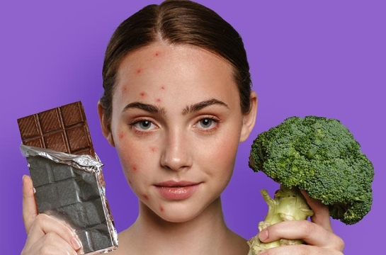 Mujer joven con acné en el rostro. En una mano toma un chocolate y en la otra un brócoli. 